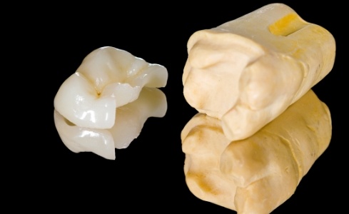 Model smile with metal free dental restoration