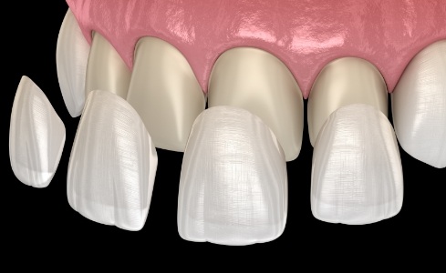 Animated smile during porcelain veneer placement cosmetic dentistry