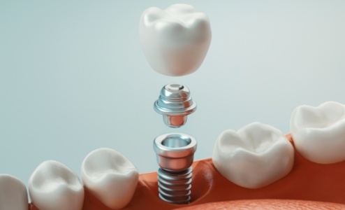 Animated smile representing the four step dental implant process