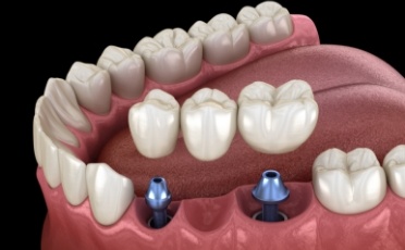 Animated smile during dental implant supported fixed bridge placement