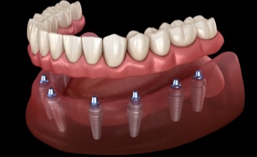 Animated smile during dental implant denture placement