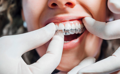 Dentist putting clear aligner on patient