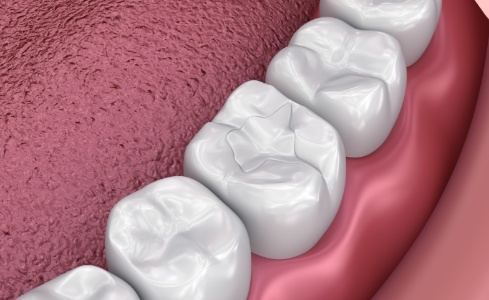 Animated smile with dental sealants