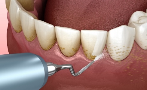 Animated smile during scaling and root planing periodontal therapy