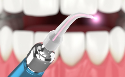 Animated smile during laser periodontal therapy