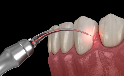 Animated smile during soft tissue laser dentistry