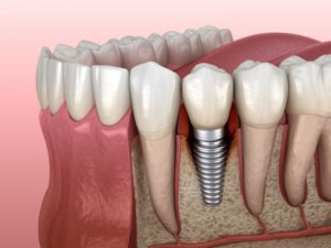 3D illustration of dental implant 