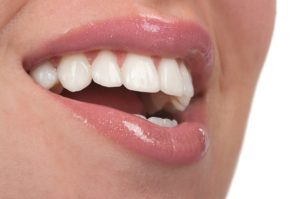 Close up of woman's teeth with veneers
