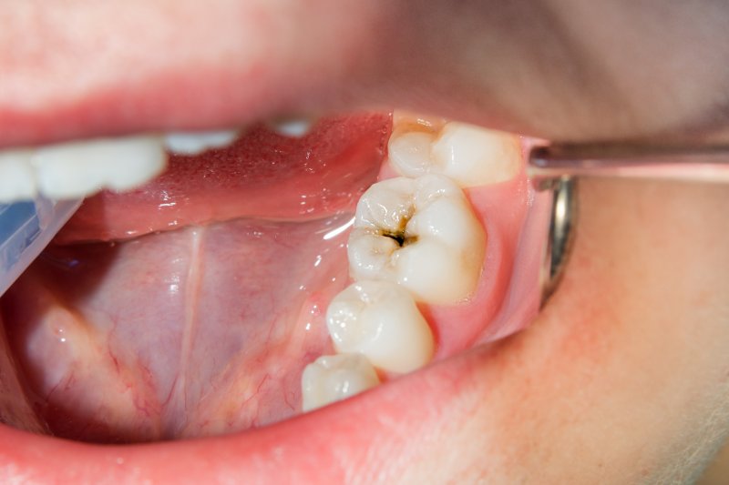 up-close view of a dental cavity